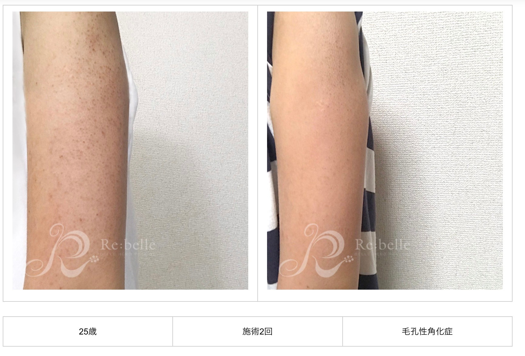 腕の体用ピーリング ビフォーアフター
